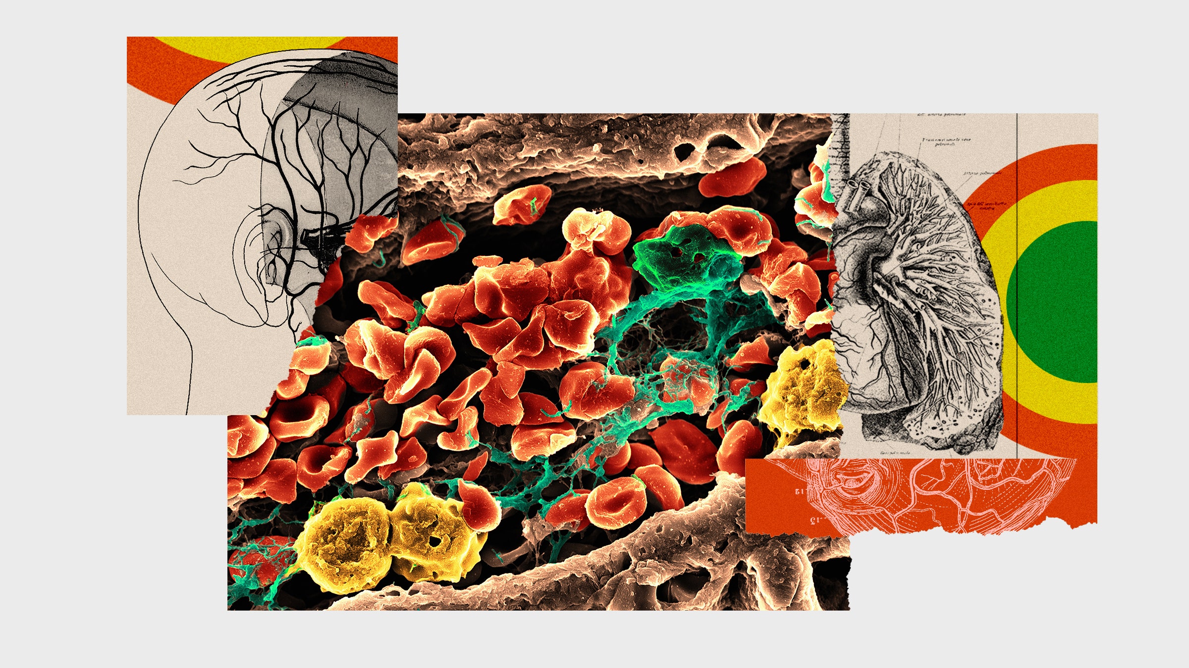 Colagem de ilustrações anatômicas de veias e imagens de coágulos sanguíneos